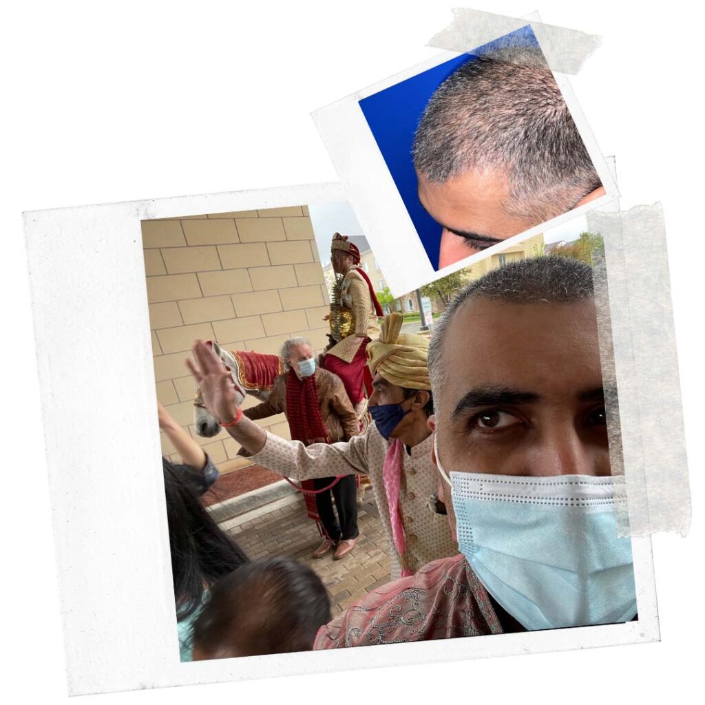 chicago top fue hair restoration doctor vinay rawlani chicago IL