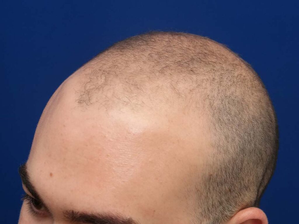 fue hair restoration pictures chicago IL