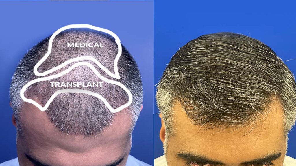 hair transplant results chicago il 1