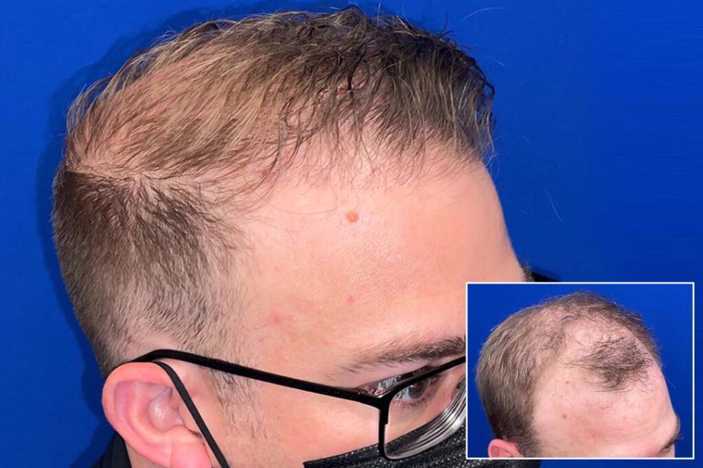 results-no-shave-fue-hair