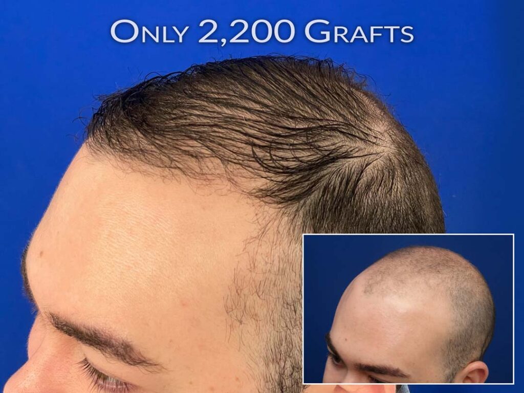 results fue hair