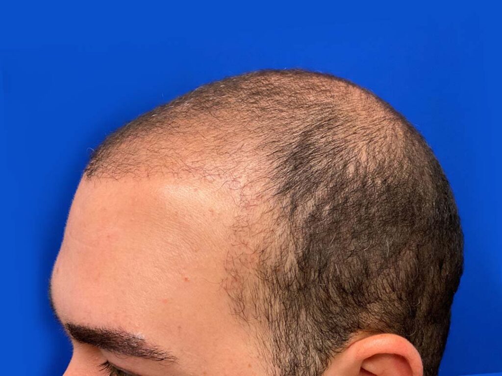 what to expect 6 months after a hair transplant chicago il 1.jpg 1